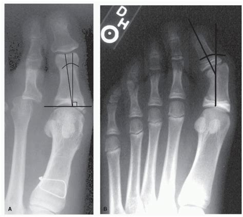 Hallux Osteotomies | Musculoskeletal Key