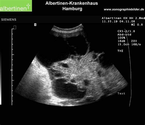 Malignant ascites in large ovarian carcinoma. | Krankenhaus, Hamburg