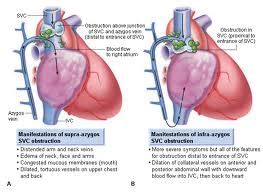 What causes the superior vena cava syndrome? | Medical Help, Health Tips