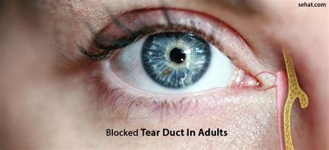 Blocked Tear Duct In Adults- Risks And Prevention Tips