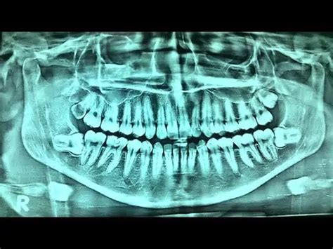 What is opg dental x-ray & how its done