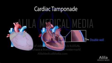 Alila Medical Media | Cardiac tamponade NARRATED animation | Medical animation