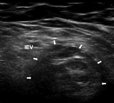 Transverse USG image of a right direct inguinal hernia (arrows) arising... | Download Scientific ...