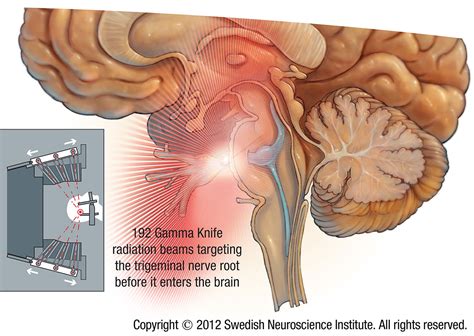 Trigeminal Neuralgia Surgery Specialists | Trigeminal Neuralgia Treatment