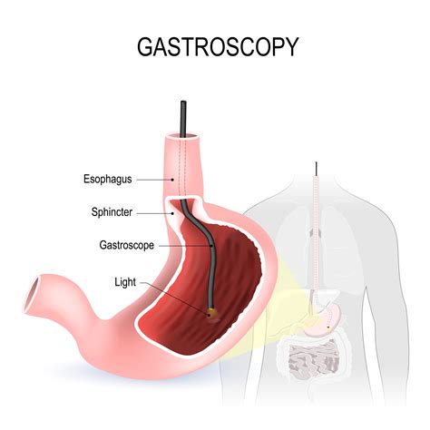 Gastroscopy Dubai | DRHC Gastroenterology Clinic