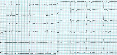 Interpretation of T‐wave inversion in physiological and pathological conditions: Current state ...