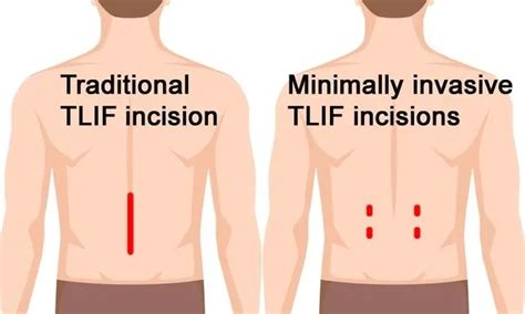 Minimally Invasive TLIF Surgery in Mumbai: Get Expert Treatment and Relief from Back Pain