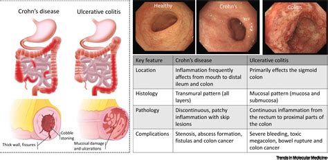 IBD disease-modifying therapies: insights from emerging therapeutics: Trends in Molecular Medicine