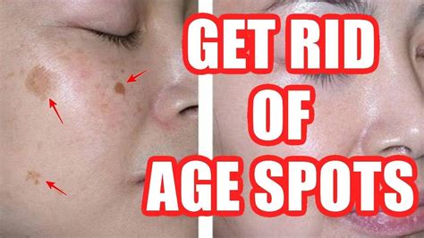 How to Get Rid of Age Spots On Face + Hands + Legs Naturally (HOME REMEDIES) - Age Spot Removal ...