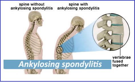 Ankylosis Spondylitis Homeopathic treatment