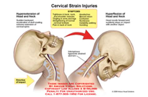 Neck Strain