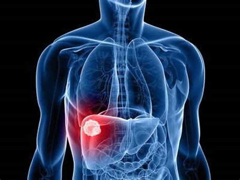 Human liver fluke infection, liver fluke life cycle, symptoms & treatment