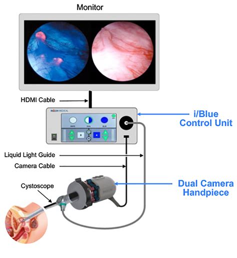 Blue Light Cystoscopy Procedure | Shelly Lighting