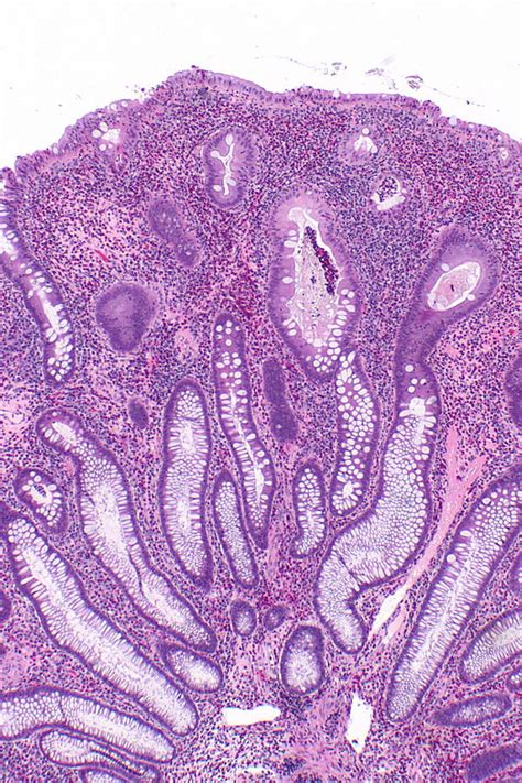 Inflammatory pseudopolyp - Libre Pathology