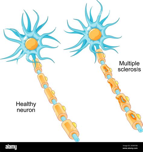 Multiple sclerosis. autoimmune disease. comparison of a healthy neuron and a neuron with a ...