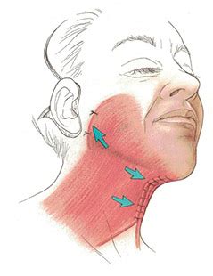 Platysmaplasty | Platysmaplasty Before and After Photos