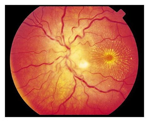 Neuritis: Retrobulbar Neuritis