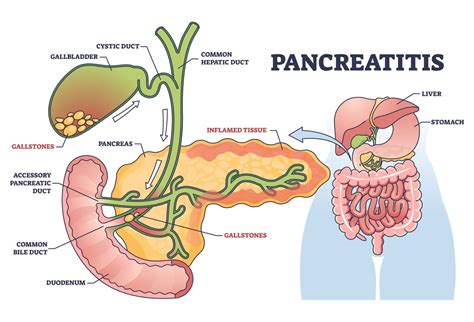 Necrotizing Pancreatitis: Causes, Symptoms, and Treatment