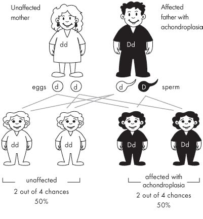 Achondroplasia : Causes, Symptoms, Diagnosis, Treatment, Prevention