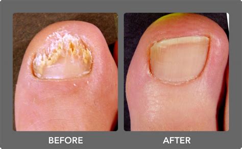 Fungal Nail Laser Treatment – Chiropody Feet First