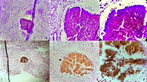 Cureus | Histopathological Diagnosis of Eumycetoma With Paraspinal ...