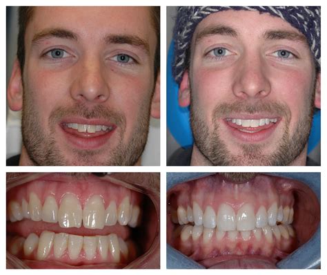 Surrey Lingual Braces Treatments for Rotated Teeth