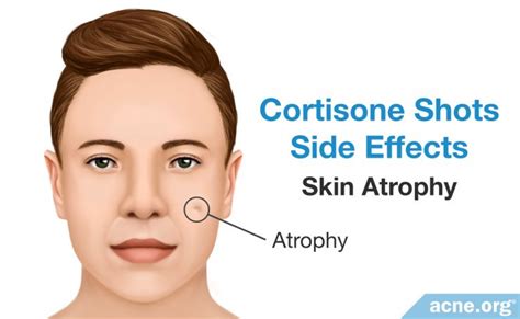 Cortisone Shots for Severe Acne - Nodules and Cysts - Acne.org