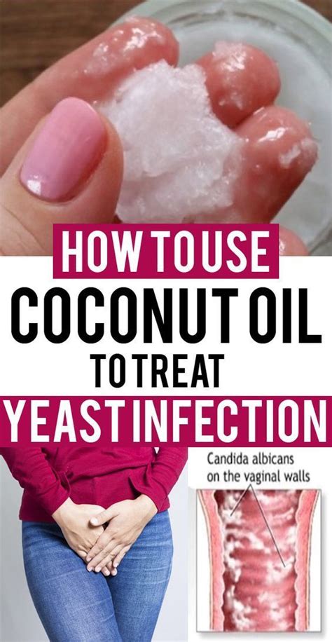 How To Use Coconut Oil For Yeast Infection? – Buzzhome World | Treat yeast infection, Yeast ...