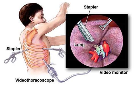 Pel's Blog » Blog Archive » VATS & Talc Pleurodesis