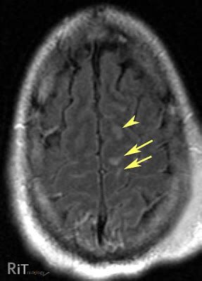 RiT radiology: Diffuse Axonal Injury