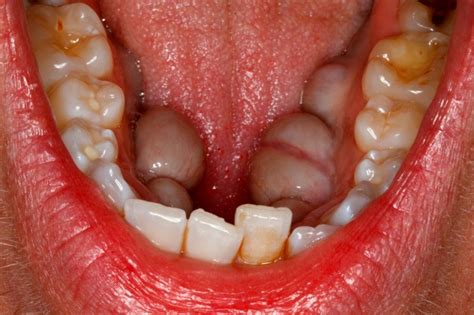 What are mandibular tori? | News | Dentagama