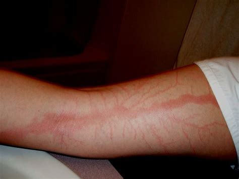 Lichtenberg Scars — Nature’s Tattoo You Don’t Want To Have | Bored Panda