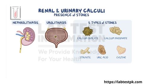 Urinary calculi