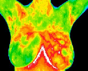 What is breast thermography & why consider it?