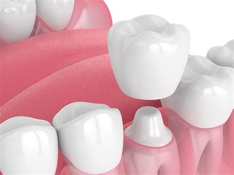 CEREC Crowns VS Traditional Dental Crowns