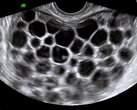 Type 2b (morphological), CE 2 (WHO), Active Cyst Fig 10- TVS pelvic ...