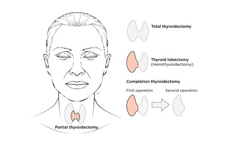 Thyroidectomy | Baylor Medicine