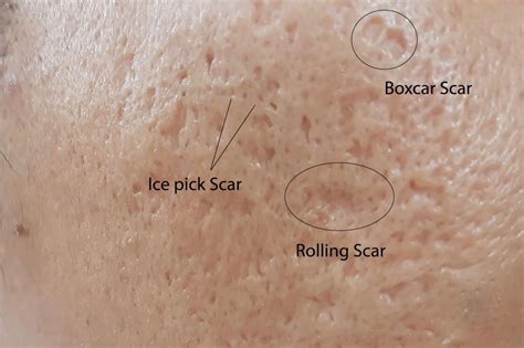 Acne Scar Treatment - Acne Scar Removal - Read more