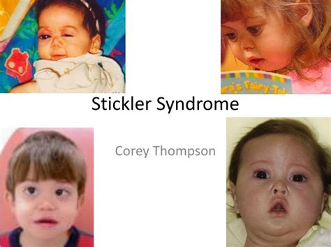 PPT - Stickler Syndrome PowerPoint Presentation - ID:2030875