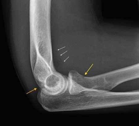 Radial neck fracture - Radiology at St. Vincent's University Hospital