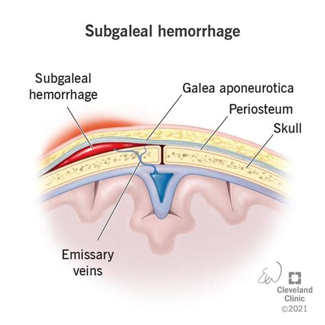 Cephalohematoma Ultrasound