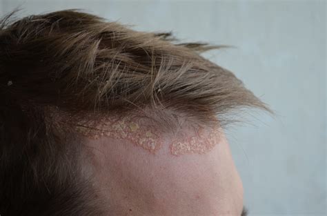 Scalp Psoriasis Treatments - Psoriasis Cure Now