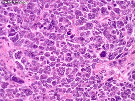 Webpathology.com: A Collection of Surgical Pathology Images