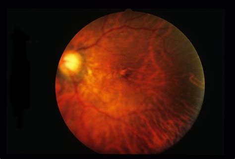 Congenital Cataracts - Retina Image Bank