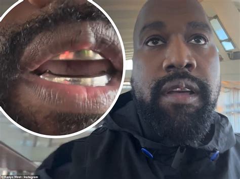 Kanye displays worrying growth on his lip after getting titanium teeth