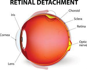 Detached retina: Causes, symptoms, treatment, and prevention