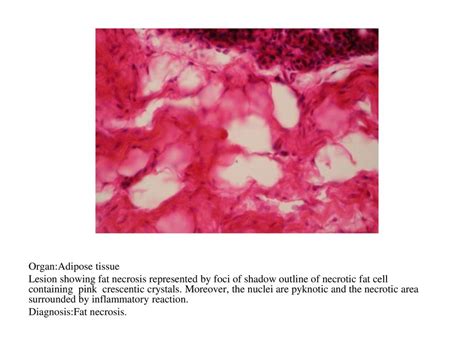 Organ:Kidney Lesion:showing coagulative necrosis represented by pyknosis, karyolysis and ...