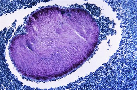 Eumycetoma Infected Tissue Sample Photograph by Cdc/science Photo ...