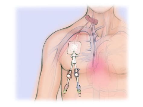 Hemodialysis Catheter — The Interventional Initiative