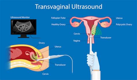 Transvaginal Sonography – Pramila IVF